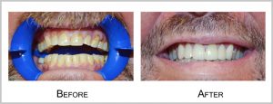 partient2before_after