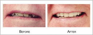 partient4before_after